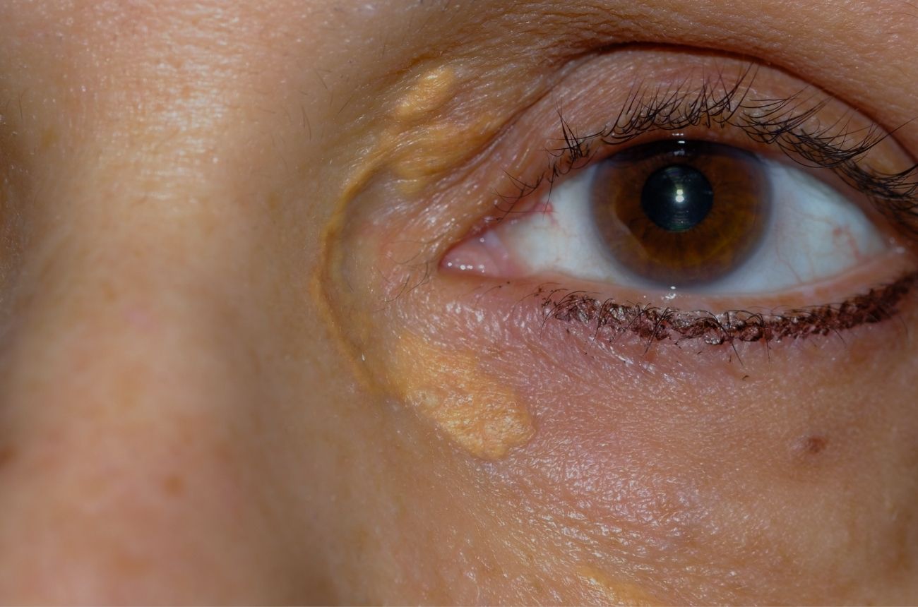 Xanthelasma Meaning, Casues & Prevention blog.cult.fit